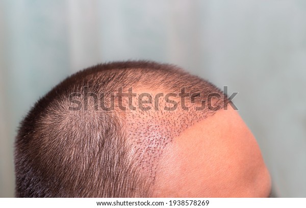 Top\
view of a man\'s head with hair transplant surgery with a receding\
hair line. -  After Bald head of hair loss\
treatment.