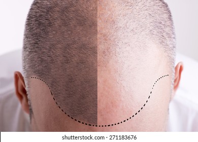 Top View Of A Men's Head With A Receding Hair Line - Before And After