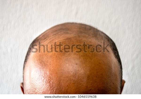 Top view of a men\'s head with a receding hair\
line Man loosing hair, baldness\
