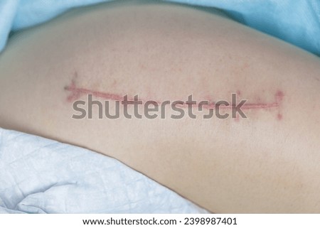 Top view of a suture on the thigh of a lying man, what the suture looks like 2 months after a total hip replacement, close up