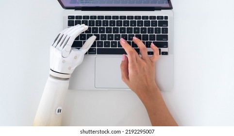 Top view woman using prosthetic arm working notebook computer, girl with disability learning , typing text artificial prosthetic limb hand