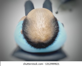 Top views soft and blurry A men asian Middle-aged man sitting on a black chair concerned with hair loss. Baldness.