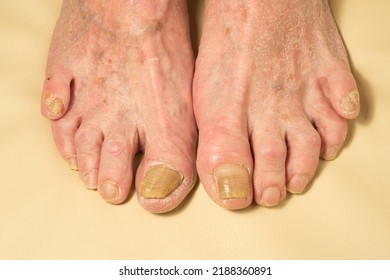 topical antifungal treatment is seen in the big toe of a person suffering from onychomycosis, a fungal infection causing yellowing of the toenail. Fungal nail infection. Advanced stage of disease. 