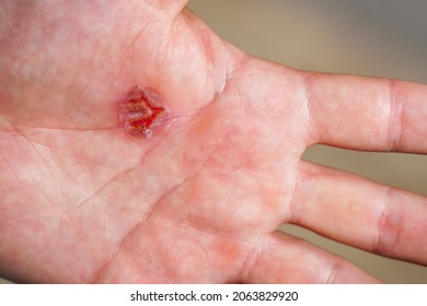 Torn Callus Of The Hand Close-up. Rough Skin Of Male Hand.