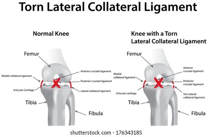 Lateral Collateral Ligament Images, Stock Photos & Vectors | Shutterstock