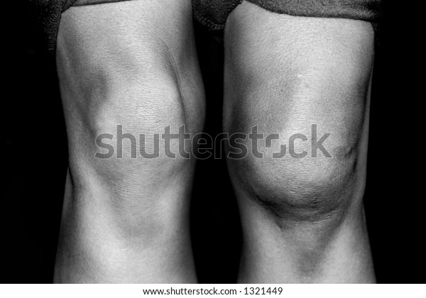 medial knee dislocation