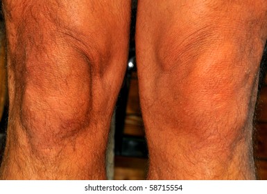 Torn Meniscus Causes Swelling Around The Left Knee Caused By Sport;