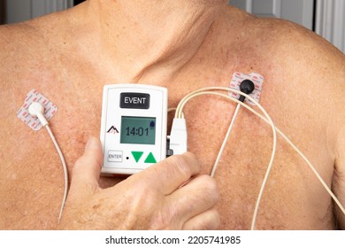 Toronto Canada, September 23, 2022; A Male Patient Wearing A North East Monitoring Holter Portable Heart Monitor Electrocardiogram (ECG) Device