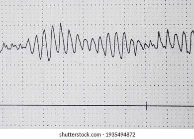 Torsade De Pointes Tachycardia In A Holter EKG 