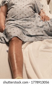 Torso And Leg Of Overweight Man In A Hospital Bed, Blood Clot Cancer Diabetes, Copy Space, Vertical Aspect