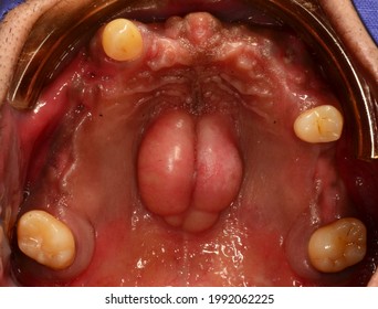 The Torus Palatinus Is Bone Exostosis At Human Palatal Bone Of Maxilla.