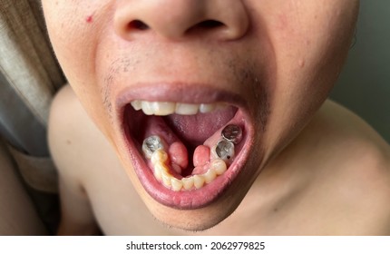 Torus Or Tori In The Patient’s Mouth Patient Got Tooth Decay And Dentist Did Fillings And Dental Crown On His Tooth