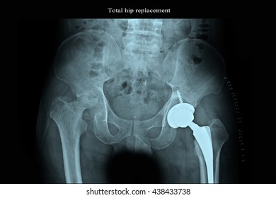 Total Hip Replacement ; THR Left