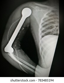 Total Humeral Replacement Following Excision For Primary Bone Tumour 