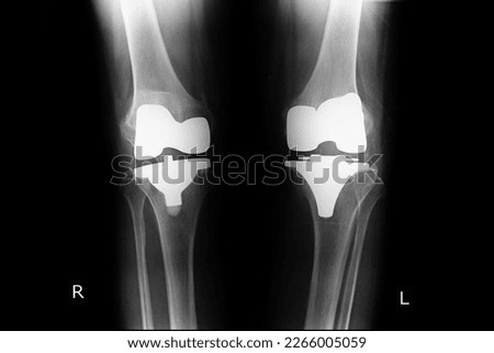 Total knee replacement both knee