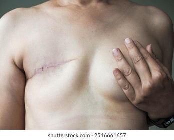 Total Mastectomy - scar of unrecognized woman from Mastectomy operation , one of the breast cancer treatment, one of the breast cancer treatment