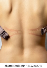 Traces of a bra on a woman's body. Uncomfortable underwear.