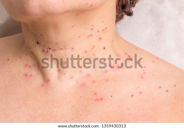 papillomavirus on neck)