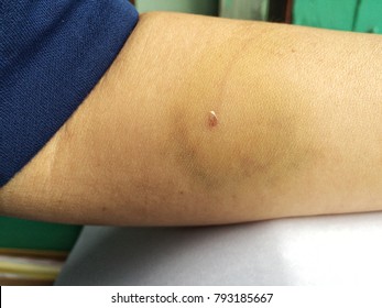 Traces Were Dog Bite On Owner Arm,Bruise On White Skin. Close-up Photo