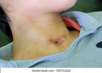 tracheostomy wound care without gauze - Shutterstock ID 559731220
