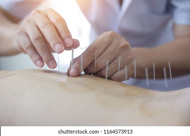 鍼灸 の画像 写真素材 ベクター画像 Shutterstock