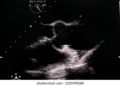 Transesophageal Echocardiogram Showing Anatomy Of Heart