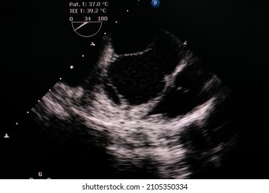 Transesophageal Echocardiogram Showing Aortic Flap  At Ascending Aorta In Patient Who Has Aortic Dissection Type A