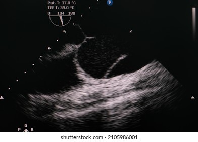 Transesophageal Echocardiogram Showing Aortic Flap At Ascending Aorta In Patient Who Has Aortic Dissection Type A