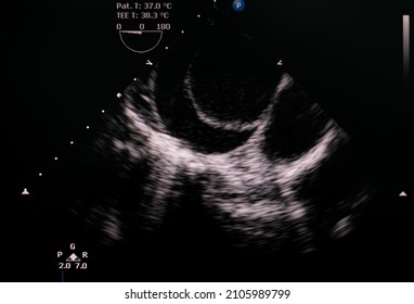 Transesophageal Echocardiogram Showing Aortic Flap At Ascending Aorta In Patient Who Has Aortic Dissection Type A