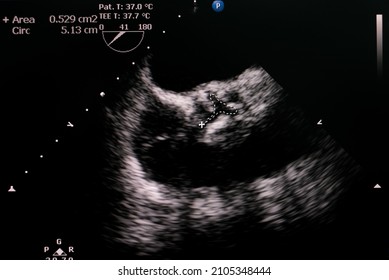 Transesophageal Echocardiogram Showing Calcified Severe Aortic Valve Stenosis