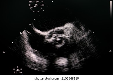 Transesophageal Echocardiogram Showing Calcified Severe Aortic Valve Stenosis