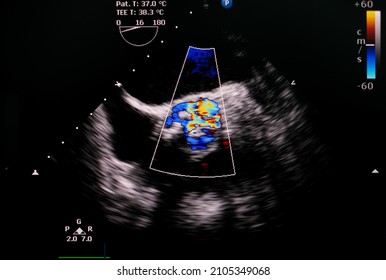 Transesophageal Echocardiogram Showing Color Flow Doppler  Of Severe Aortic Valve Stenosis