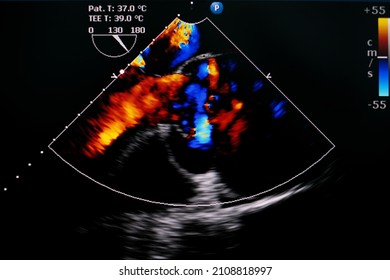 Transesophageal echocardiogram showing color flow doppler through aortic valve and aortic flap at ascending aorta