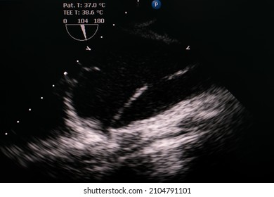 Transesophageal echocardiography showing aortic flap in patient who has aortic dissection type A