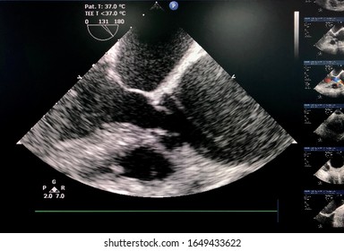 Transesophageal Echocardiography (TEE) Showed Ascending Aortic Dilatation. Aortic Aneurysm Or Dissection Type A.