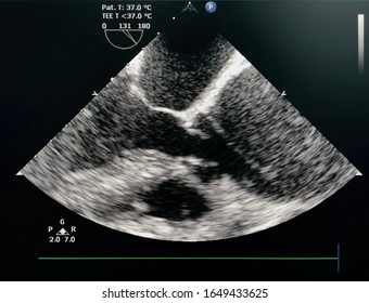 Transesophageal Echocardiography (TEE) Showed Ascending Aortic Dilatation. Aortic Aneurysm Or Dissection Type A.