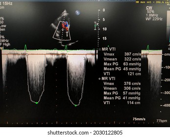 Transthoracic echocardiogram (TTE) shown measurement severity of mitral valve regurgitation (MR).