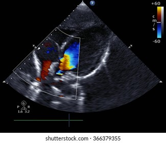 Transthoracic Two-dimensional Color Doppler Echocardiography