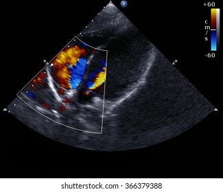 Transthoracic Two-dimensional Color Doppler Echocardiography