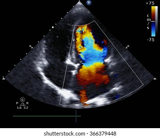 Transthoracic two-dimensional color Doppler echocardiography
