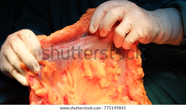 Transverse\
Colon during surgery for Right\
Hemicolectomy