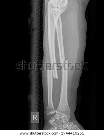 transverse fracture on radius dan ulna bone hand fracture
