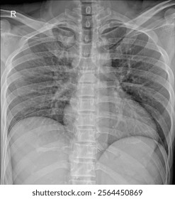 Trauma Imaging: Chest X-ray for Rib Fractures