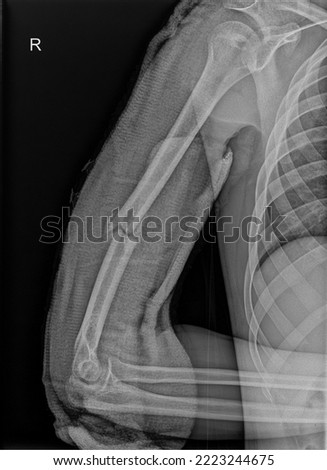 Trauma X-Ray  Upper Limb Humerus fractures 
