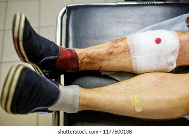 Traumatized By The Bloody Human Foot With A Temporary Bandage On A Hospital Bed In A Building Emergency Room Waiting For The Doctor, After A Car Accident. Close-up.