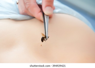 Treatment With Bee Stings. Apitherapy