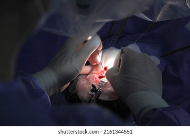 Treatment Of A Brain Aneurysm. Surgical Operation On The Brain. A Team Of Surgeons Performing Brain Surgery To Remove A Tumor.