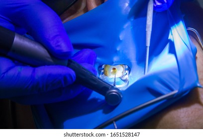 Treatment of dental canals in the upper molar permanent molar using an apex locator file, a tooth with a clip attached to it with a cofferdam. - Shutterstock ID 1651528147