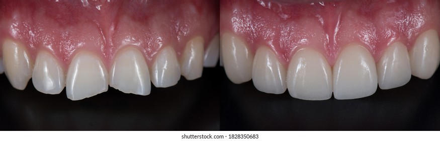 Treatment For Front Teeth Fracture With Dental Ceramic Veneers.