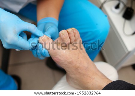 Treatment of an ingrown toenail for a man. Relief of pain. Podology treatment. Podiatrist treating toenail fungus. Doctor removes calluses
